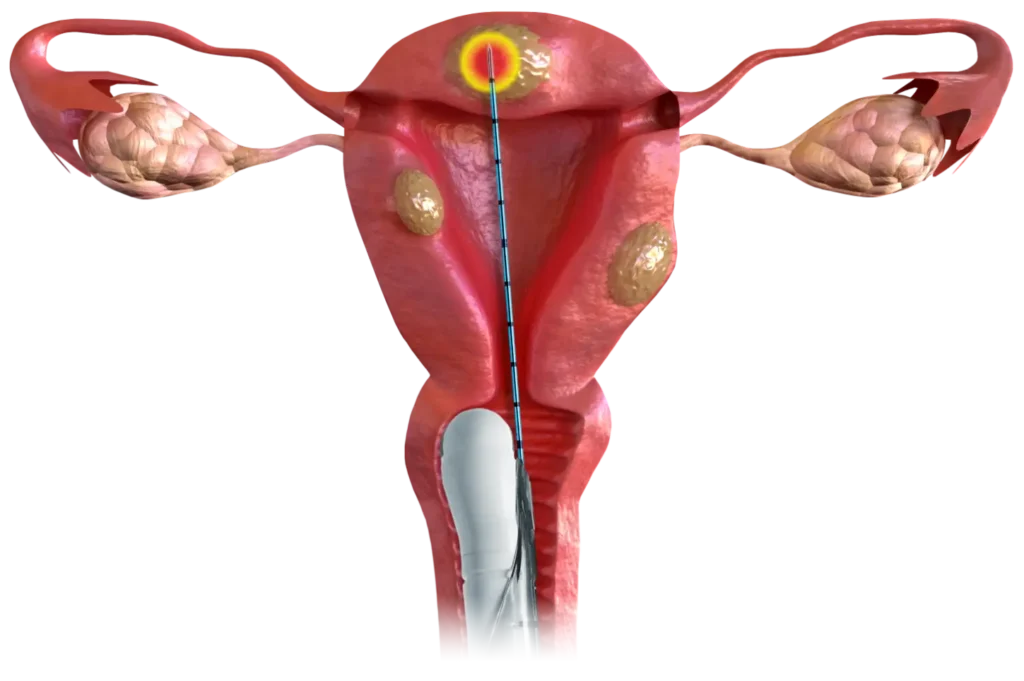Cross-section illustration of a uterus