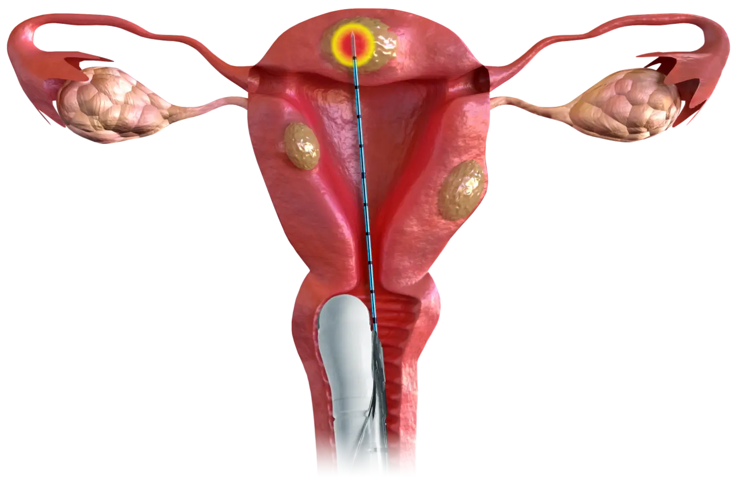 Cross-section illustration of a uterus