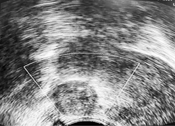 5.8 mL type 5/6 Myoma. No vascularity after RFA