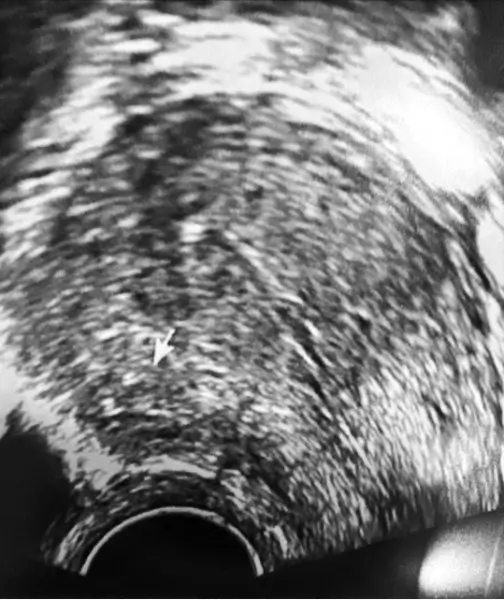 The myoma is undetectable 1-year after RFA