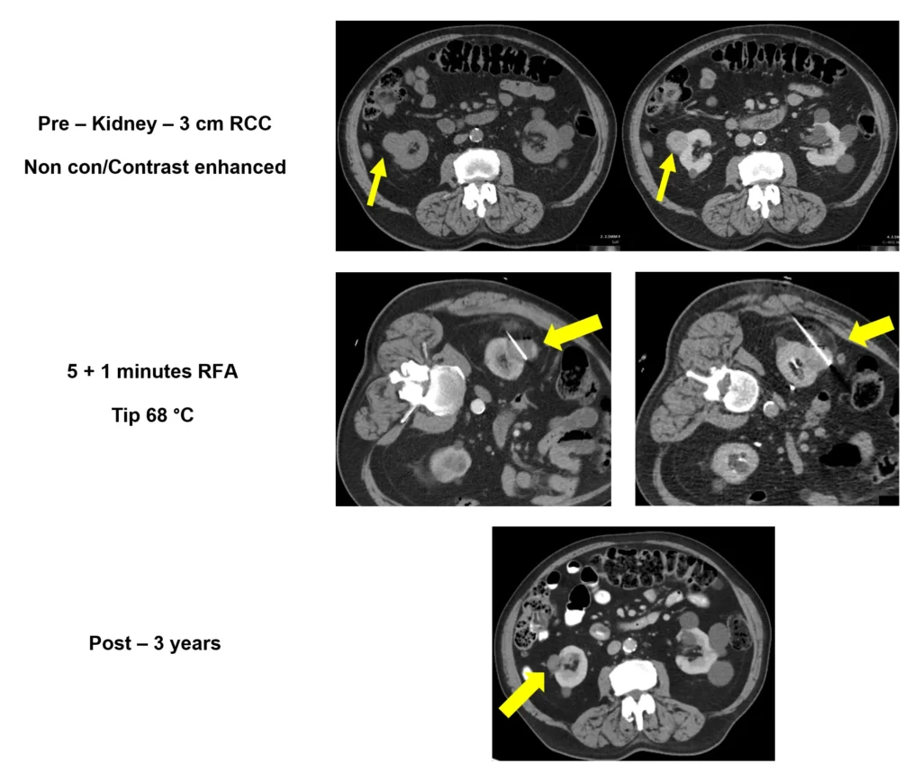 Kidney Case Scans