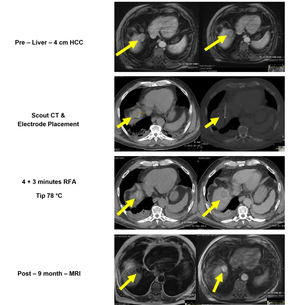 Liver Scans