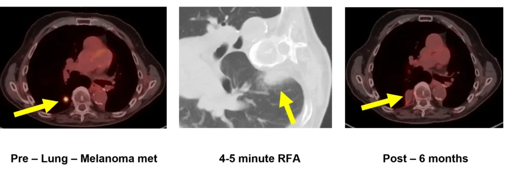 Melanoma Metastasis Scans