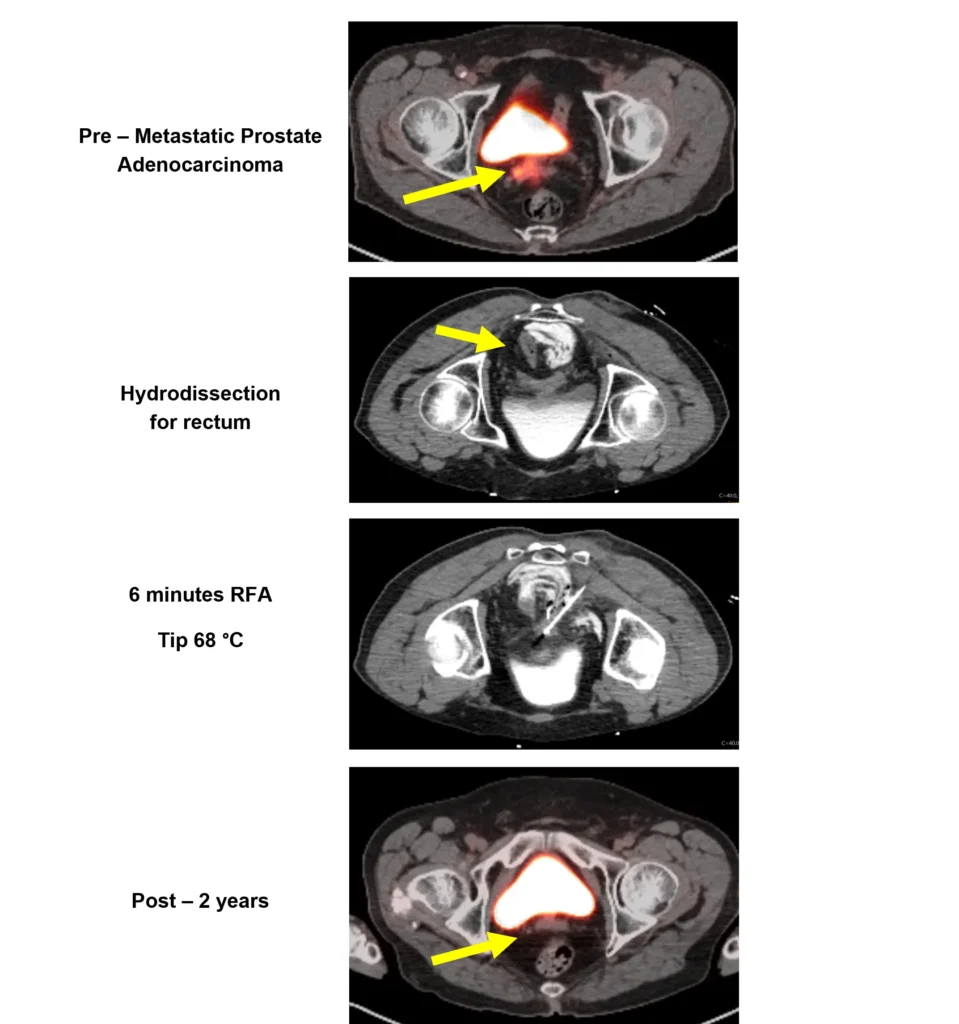 Prostate Scans